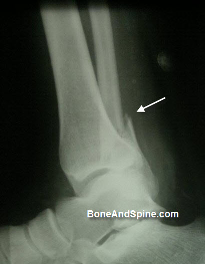 lateral View of Lateral Malleolus fracture With Ankle Subluxation