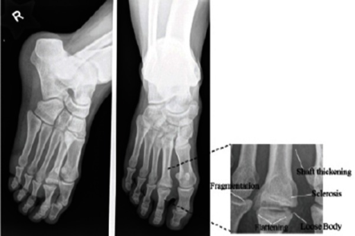 kezdeti osteochondrosis a belső könyökízület kezelése