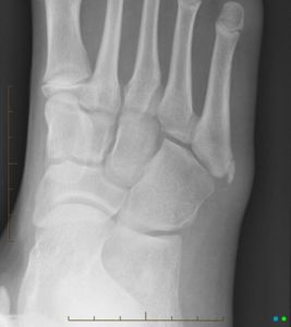 X-ray of iseline disease