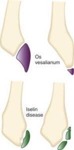 Os vesalnium and Iselin disease