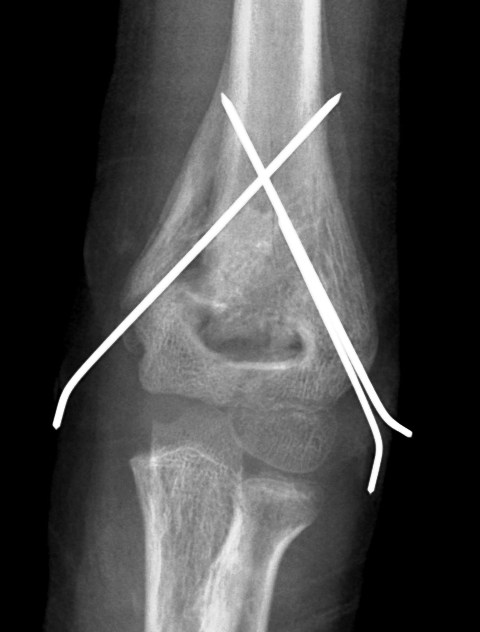 AP View Of United Supracondylar Fracture of Humerus Fixed WIth Kwires