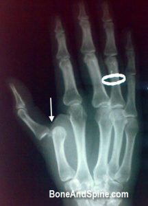 dislocation-MP joint