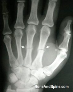 United Metacarpal Fracture With Callus