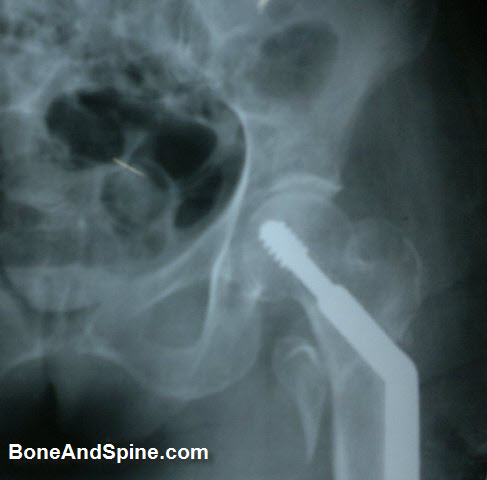 United Intertrochanteric Fractiure WIth Dynamic Hip Screw In Situ