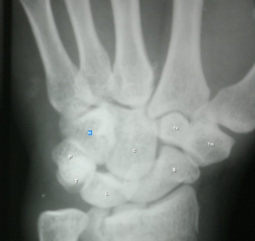 carpal bones xray