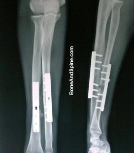 Operated Fracture Radius Ulna With DCP In Situ