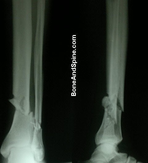 X-ray of Fracture of Tibia and Fibula In Distal Part of Leg