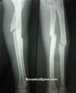 Fracture Radius and Ulna