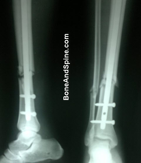 Fracture of TIbia and Fibula with Tibia Fixed With Interlock Nail