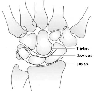 Gilula Arcs, These are disturbed in wrist Instability