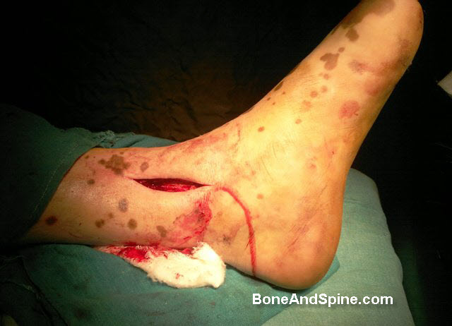 Incision over distal tibia