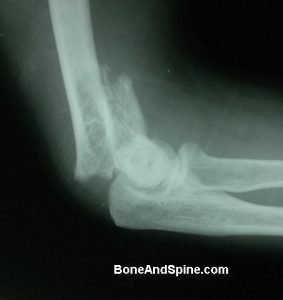 Fracture of Humerus In Distal Part