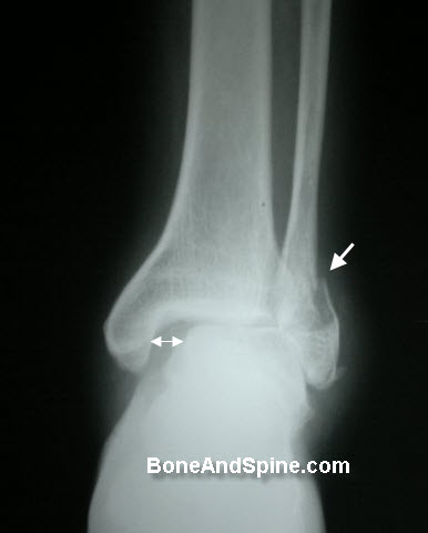 Fracture Lateral Malleolus With Subluxation of Ankle