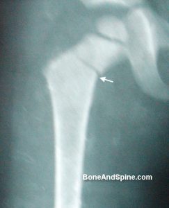 fracture neck femur in a child