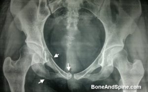 Fracture superior inferior pubic rami