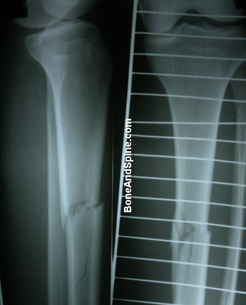 Transeverse Comminuted Fracture TIbia
