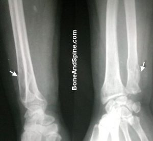 Comminuted Fracture of Distal Part of Ulna