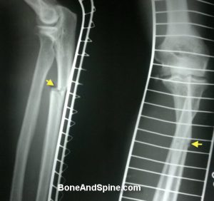 Fracture Shaft of Ulna