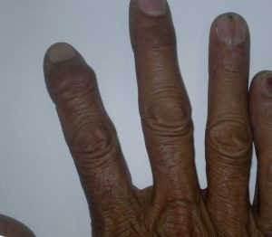 Mallet Finger Deformity In Index Finger