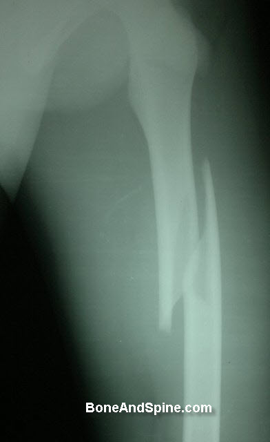 oblique fracture