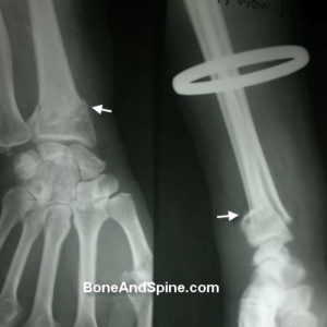 Fracture of Distal Radius