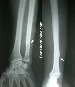 Minimally Displaced Fracture of Ulna