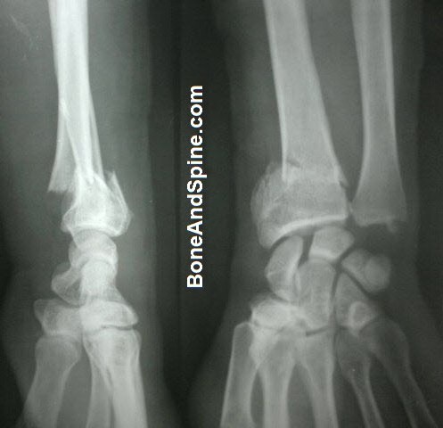 Fracture of Distal End Radius