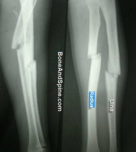 fracture of Radius and Ulna