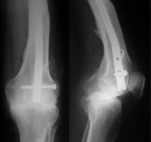 Intramedullary Supracondylar Nail In Fracture Femur or retrograde nail