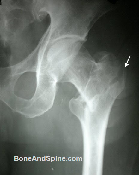 Xray of Intertrochanteric Fracture