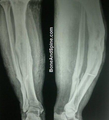 Osteomyelitis of Tibia With Bowed Tibia