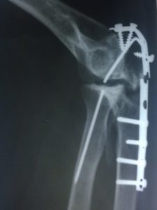 Broken Implant In Elbow