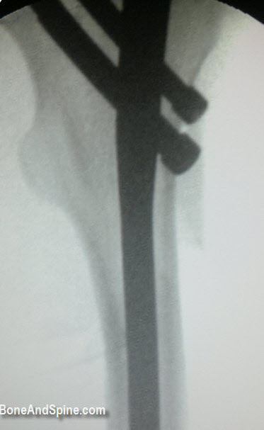 Intraoperative Carm Image of The Fracture After Reduction and Internal Fixation