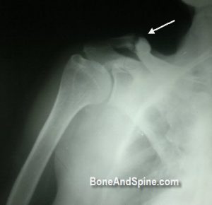 Shoulder Injuries - Xrays and Photographs | Bone and Spine