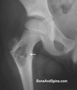 Aneurysmal Bone Cyst In Neck Of Femur - Xray