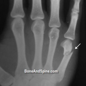 Fracture Fifth Metacarpal