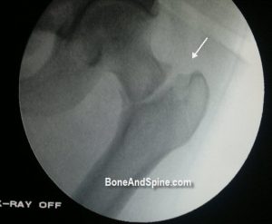 Intertorochanteric Fracture of Femur