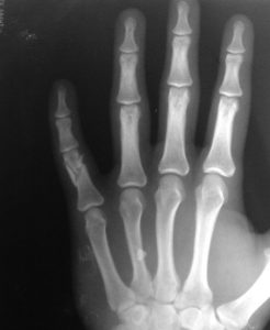 Comminuted Fracture Proximal Phalanx of Little Finger