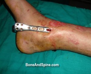 Peroperative Clinical Photograph Showing Percutaneus Insertion of Distal Tibial Plate For Distal Tibial Fracture