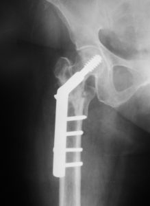 Lateral view Xray After 5 Months Shows United Fracture