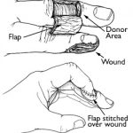 cross-finger-flap