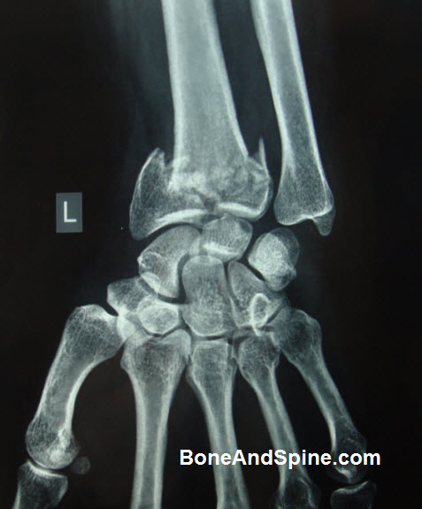 Comminuted Fracture Distal End of Radius - AP view