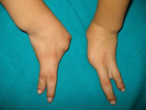 Ectrodactyly in both hands