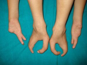 Ectrodactyly hands and feet together