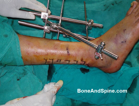 External Fixator Applied To Tibia