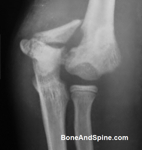 distal humerus anatomy