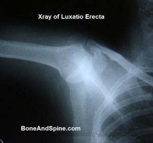 Xray of Luxatio Erecta