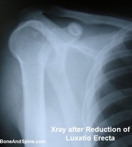 Xray of Luxatio Erect After reduction