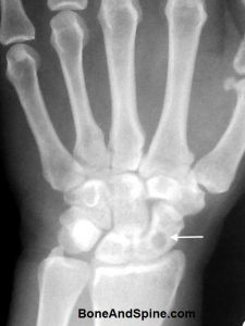 Lytic Lesion Scaphoid