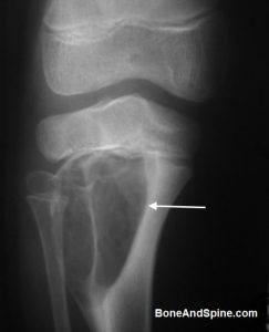 Lytic Lesion Upper End Tibia